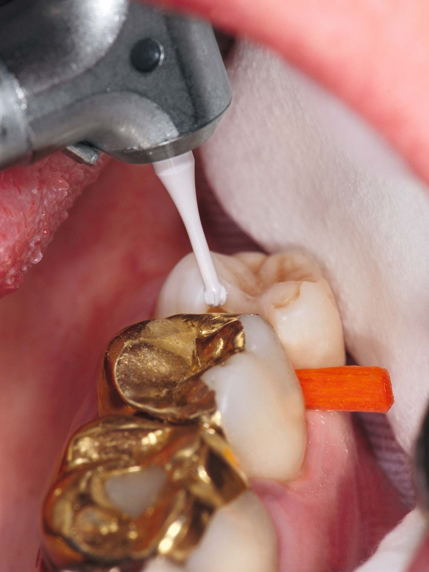 Clinical Image of an excavation using the Komet K1SM