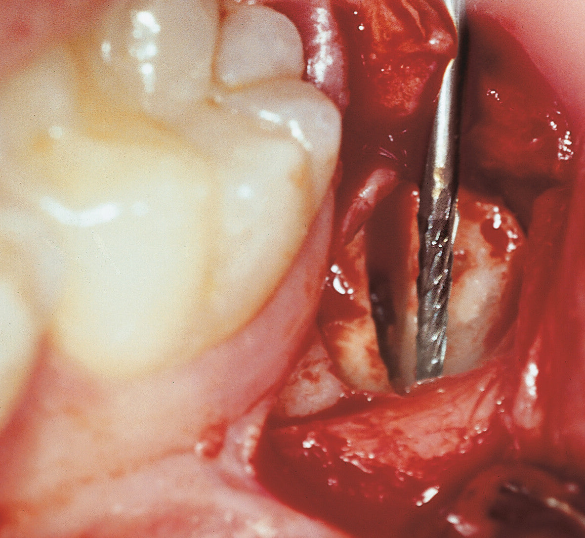 Komet H254E dental bur for bone and tooth preparation